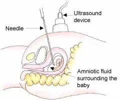 Graphic representation of the amniocentesis procedure