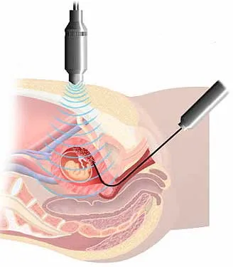 Graphic representation of CVS done under ultrasound guidance.